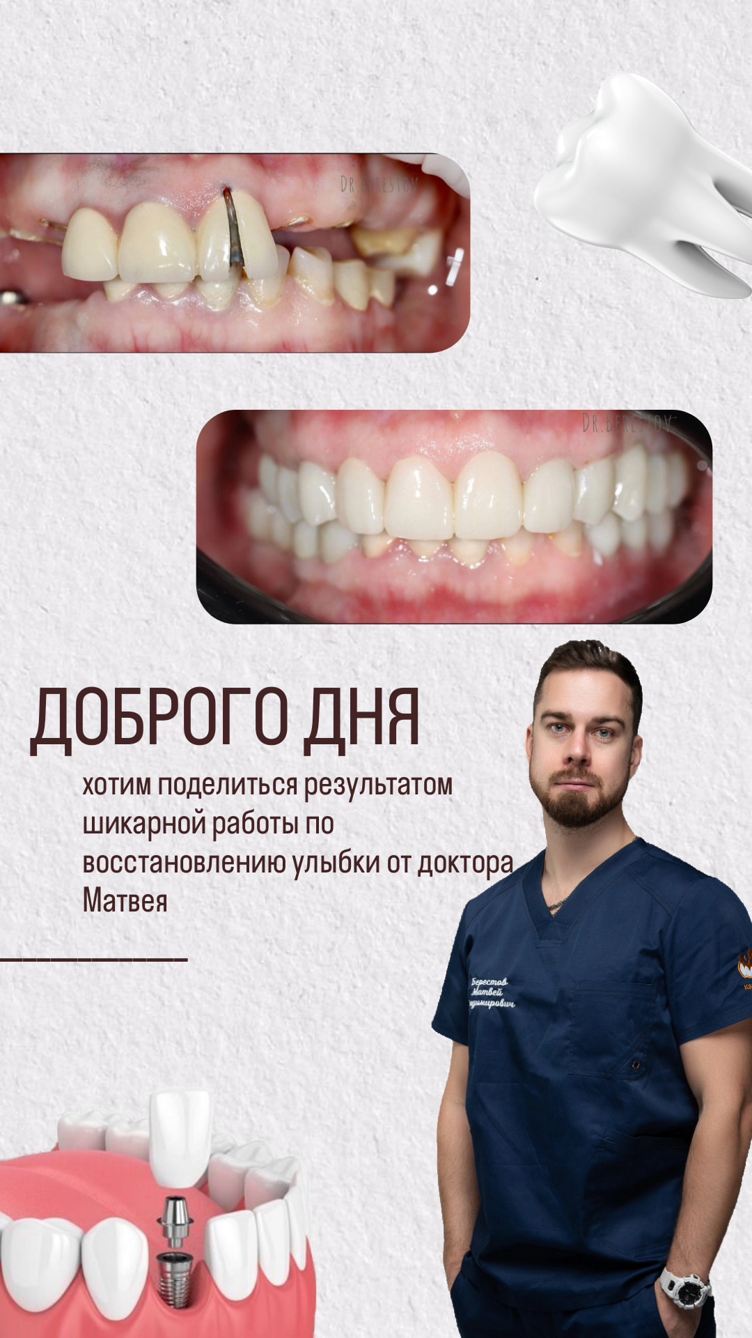 Пломбирование зубов