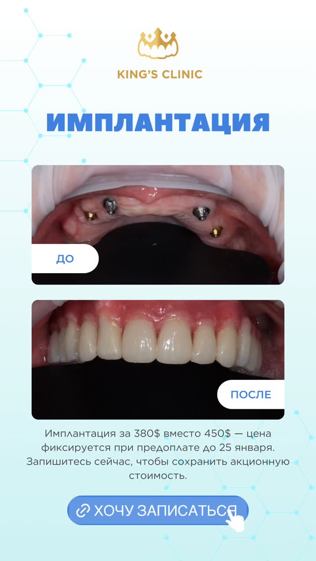Имплантация зубов