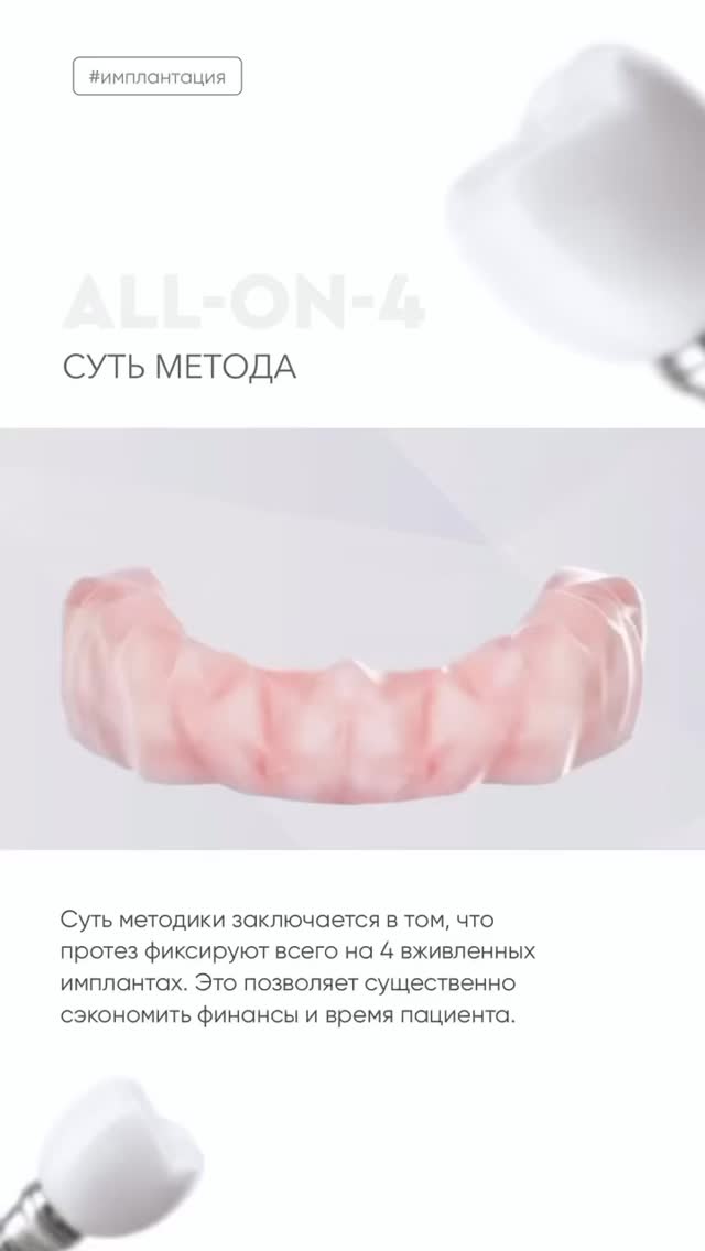 Имплантация ALL-ON-4