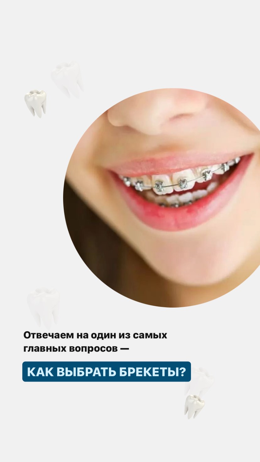Брекеты