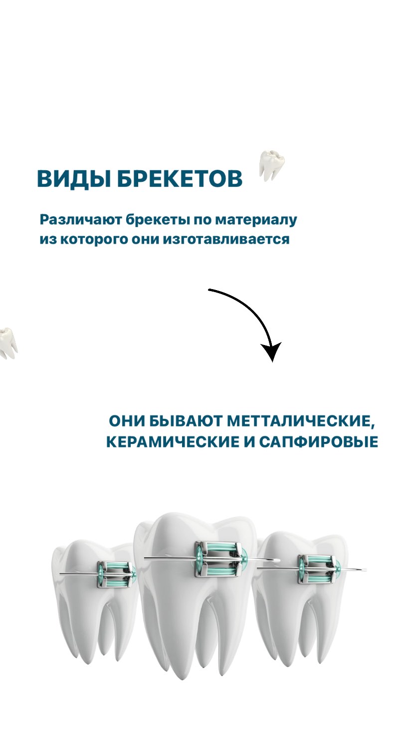 Брекеты