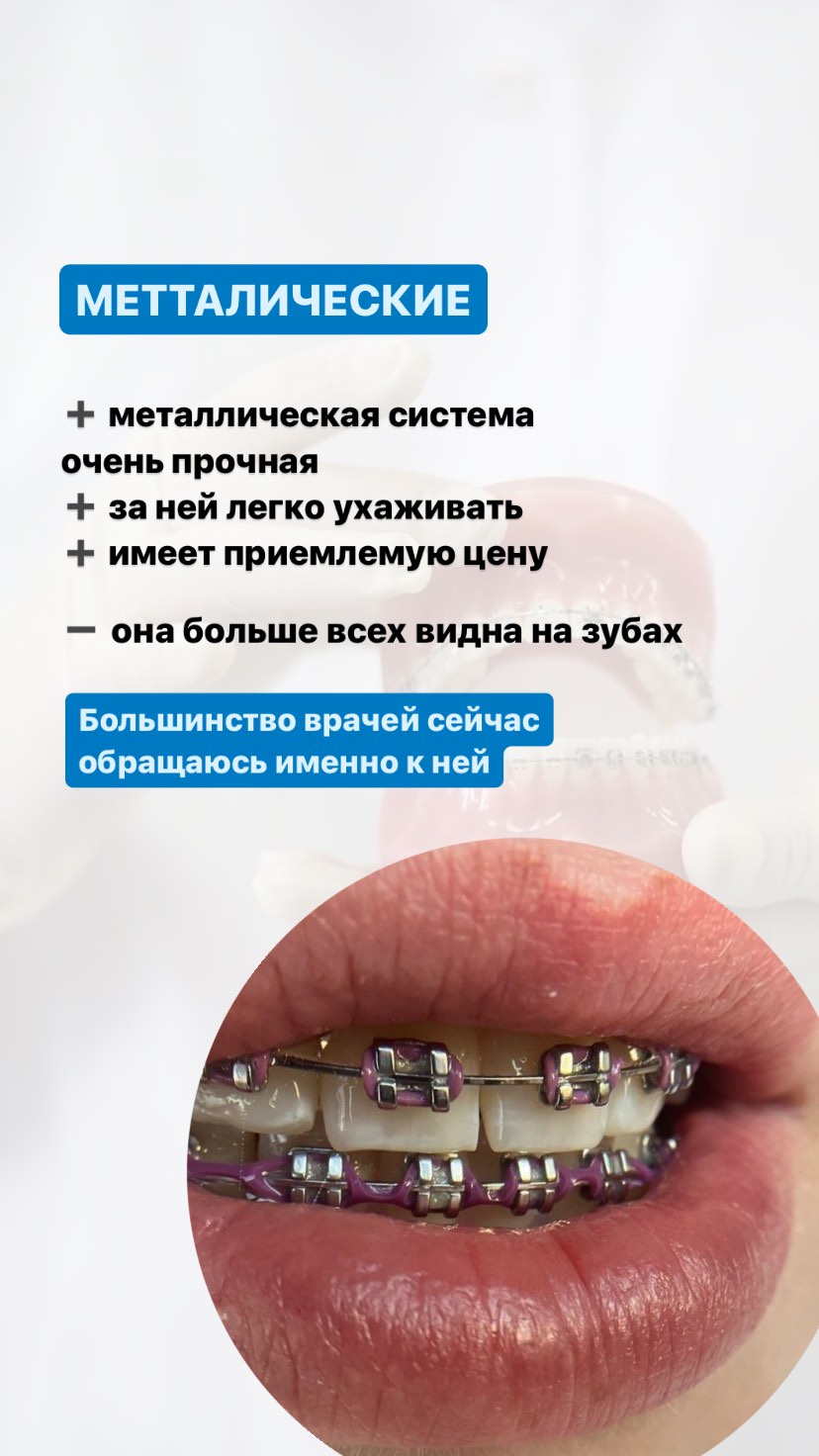 Брекеты