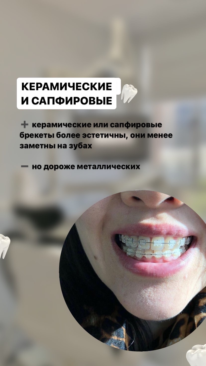 Брекеты